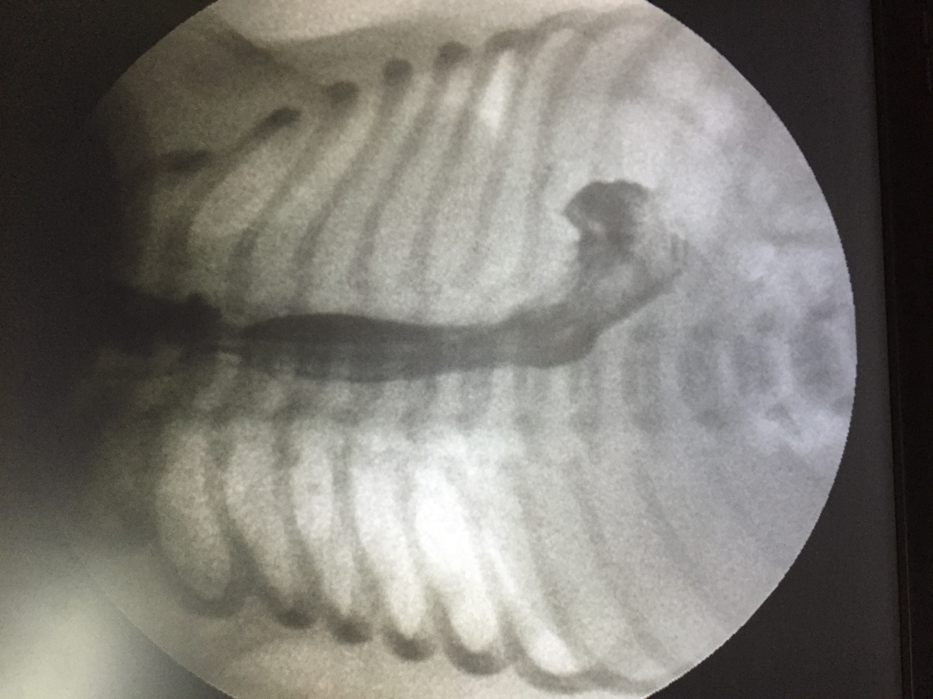 Thoracoscopic TEF Repair